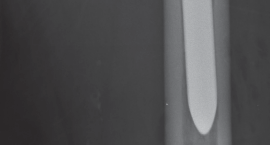 Illustration 58 for Femoral Stem Revision: Posterior Approach for Better Outcomes