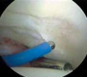 Illustration 23 for Solving Hip Soft Tissue Pathology with Advanced Arthroscopy