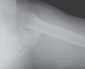 Illustration 4 for Mastering Pediatric Shoulder Fractures: Clinical Insights