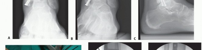 Illustration 28 for Optimize Pain Management with Proximal Ring Block for Ankle Arthrodesis