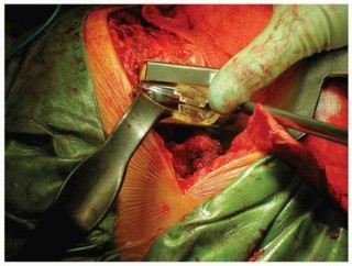 Illustration 34 for Why Polished Tapered Cemented Stems Excel in Hip Replacement