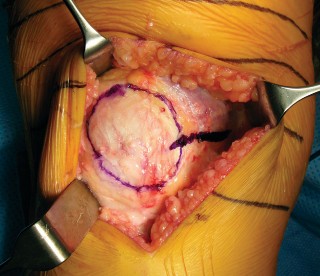 Illustration 3 for Minimally Invasive Subvastus: The Best Path to Quicker TKA Recovery