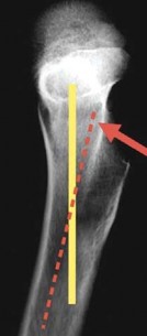 Illustration 3 for Mastering Cementing Technique Femur: A Step-by-Step Guide