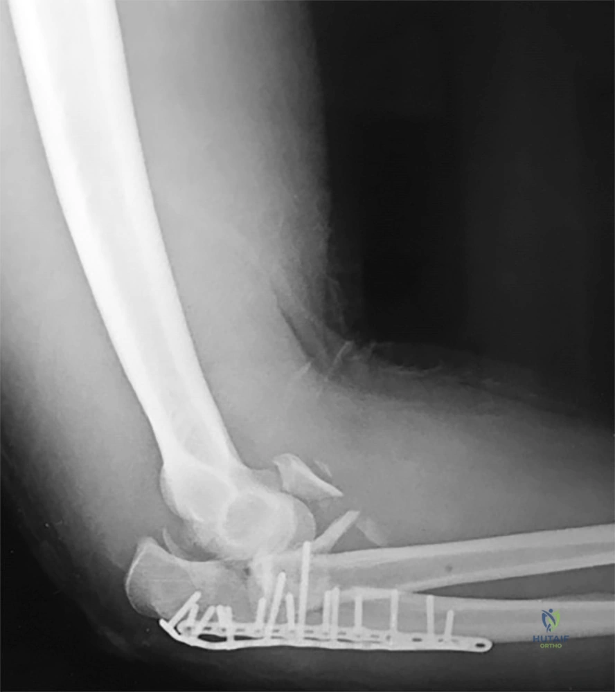 Free Elbow MCQs: Master Shoulder & Elbow Orthopedics