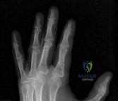صورة لعلاج طبيعي للركبة
