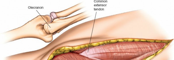 Illustration 16 for Mastering Elbow Approaches: Applied Surgical Anatomy for Precision