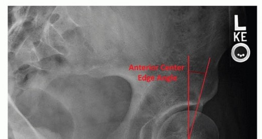 Illustration 5 for Restore Hip Health: Pelvic Osteotomy for Acetabular Dysplasia & CEA of Less