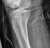 Illustration 13 for Tibial Fracture Extending into the Plafond: Intramedullary Secrets