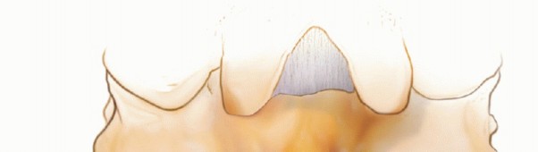Illustration 9 for Achieve Stability: Posterior Cervical Lateral Mass Screw Fusion