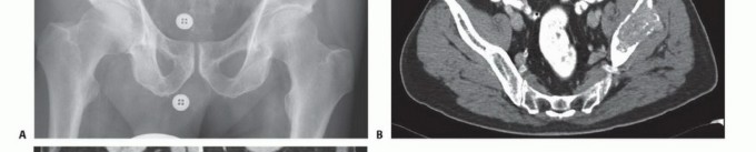 Illustration 8 for Pelvic Metastasis Surgery: A Component of the Utilitarian Approach