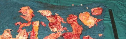 Illustration 19 for Optimizing Infected THA: The One Staged Approach Explained