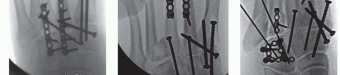 Illustration 23 for Fixation of Lisfranc Injuries: Essential Open Reduction Guide