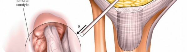 Illustration 23 for Mastering Knee Approaches: Spotlight on Superficial Medial Ligament