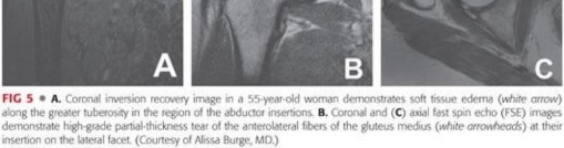 Illustration 57 for Periarticular Arthroscopy: Addressing Medius & Minimus Tears