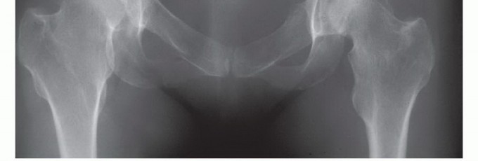 Illustration 30 for Pelvic Metastasis Surgery: A Component of the Utilitarian Approach