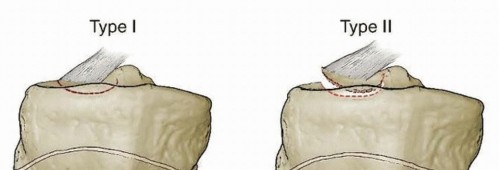 Tibial Spine Fractures: Surgical Options & Hinged Knee Brace Stability