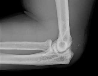 Elbow Pop & Pain? What a Triceps Tendon Rupture Means