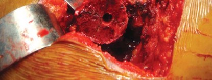 Illustration 35 for The Silent Hip: Achieving a Truly Silent, Pain-Free Joint