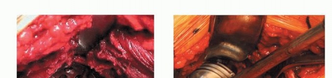 صورة توضيحية لـ استبدال مفصل الورك بدون أسمنت: استعادة الحركة والثبات في صنعاء مع الأستاذ الدكتور محمد هطيف