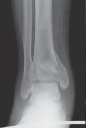 Illustration 19 for Optimizing ORIF for Tibial Plafond Fractures: A Modern Approach