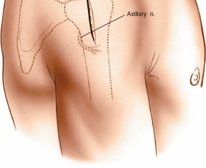 Illustration 102 for Essential Guide: Mastering Every Approach to the Shoulder