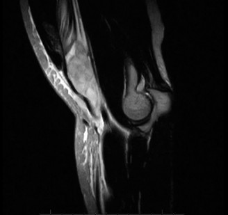 Illustration 2 for Distal Biceps Tendon Injury: Crucial Steps for Optimal Diagnosis & Care