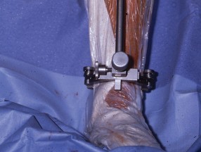 Illustration 39 for Mastering TKA: Essential Methods of Rotational Alignment