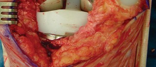 صورة طبية: مراجعة استبدال الركبة الجزئي الفاشل دليلك الشامل للعلاج الناجح في صنعاء