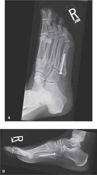 كسر جونز في مشط القدم الخامس: دليل شامل للتشخيص والعلاج والتعافي مع الأستاذ الدكتور محمد هطيف