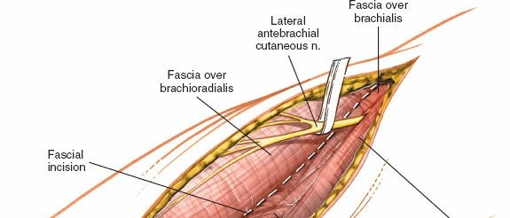 Illustration 57 for Mastering Elbow Approaches: Applied Surgical Anatomy for Precision