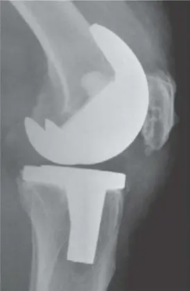 التهاب مفصل الركبة الصناعي: دليل شامل للمرضى وخيارات العلاج المتقدمة في صنعاء