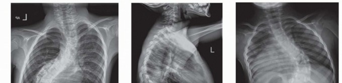 Growing Rod Instrumentation: What You Need to Know for Early Scoliosis