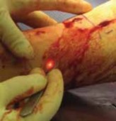 Illustration 51 for Optimal Nailing of the Tibia: Techniques for Challenging Fractures