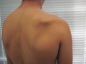 Illustration 39 for Right Shoulder Pain? Avoid This Common X-ray Mistake.