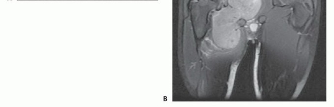 Illustration 6 for Optimizing Adductor Muscle Group Resection for Limb Preservation
