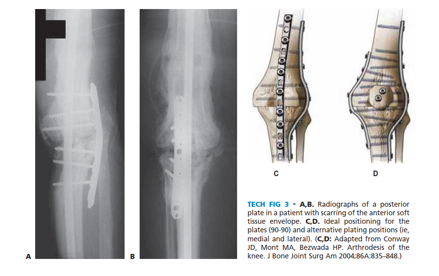Illustration 13 for Knee Arthrodesis: A Lifelong Knee Solution for Trauma & TKA