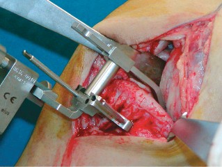 صورة طبية: جراحة استبدال مفصل الركبة الجزئي (UKA): تجنب الأخطاء والاستفادة القصوى في صنعاء مع الأستاذ الدكتور محمد هطيف