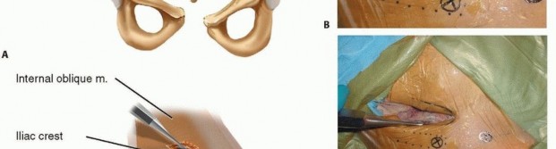 Illustration 15 for Emergency Fixation of the Pelvis: Control Bleeding & Restore Stability