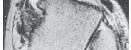 Illustration 10 for Beyond Primary Repair: Solutions for Peroneal Tendon Subluxation