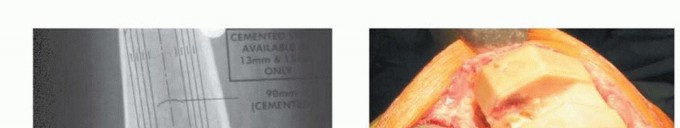 Illustration 4 for Femoral Bone Loss: Metal Augments for Revision Knee Success