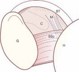 Illustration 4 for Arthroscopic Subscapularis Repair: The lo iky brady Method for Stability