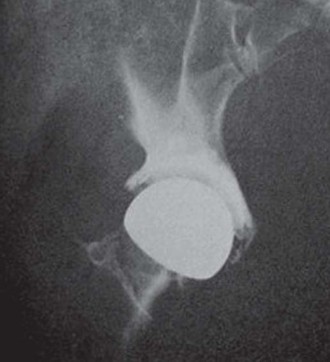 Illustration 5 for Mastering Hip Arthroplasty: Its Evolution and Design Unveiled