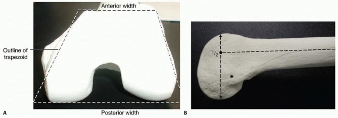 Repairing Distal Femur Fractures: Open Reduction & Internal Fixation