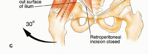 Illustration 25 for Surgical Pelvic Resection: Gluteus Maximus Muscle & Nerve Preservation