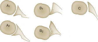 Illustration 24 for Right Shoulder Pain? Avoid This Common X-ray Mistake.