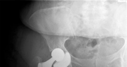Illustration 18 for Mastering Direct Anterior Approach Hip Arthroplasty Without a Traction Table