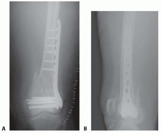 Illustration 73 for Repairing Distal Femur Fractures: Open Reduction & Internal Fixation