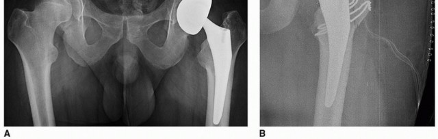 Illustration 13 for Sliding Trochanteric Osteotomy: Modern Role & Refined Techniques
