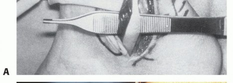 Illustration 2 for Beyond Primary Repair: Solutions for Peroneal Tendon Subluxation