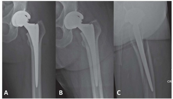 Illustration 7 for Mastering Fixation of Periprosthetic Fractures of the Femur